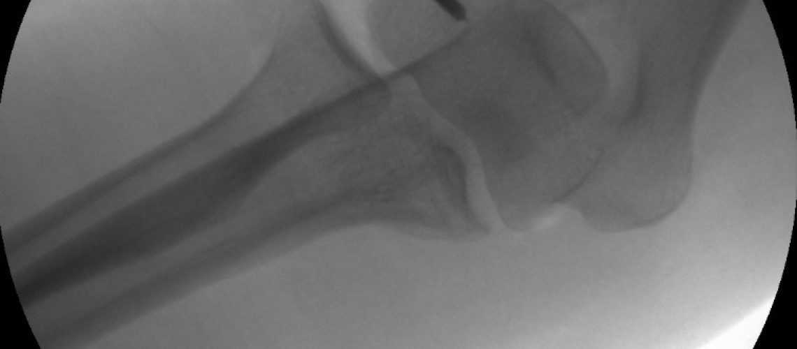 PLRI_INTRAOP_XR