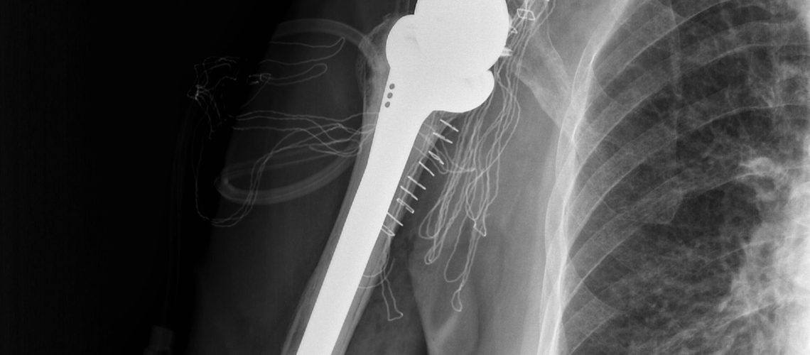 RSA_CUFF ARTHROPATHY