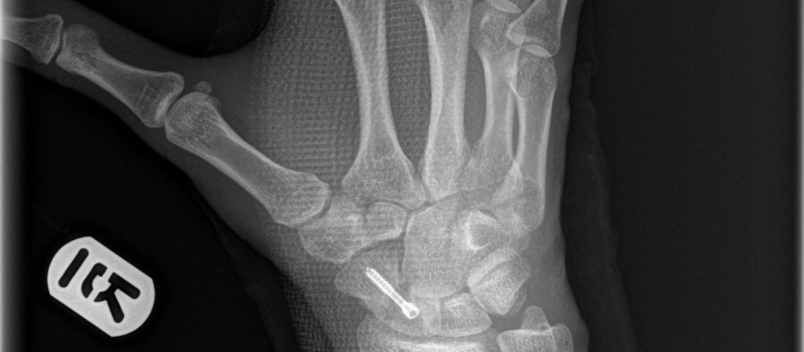 SCAPHOID FX_POSTOP2