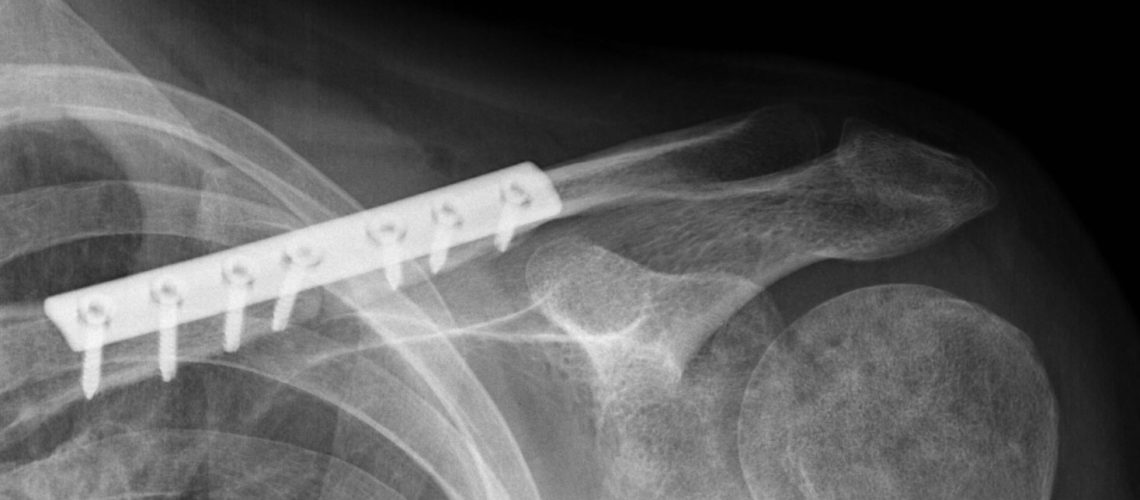 clavicle nonunion orif