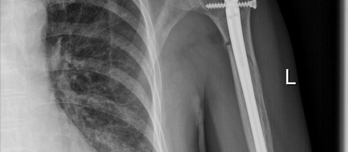 HUMERUS FX_IMN_POSTOP