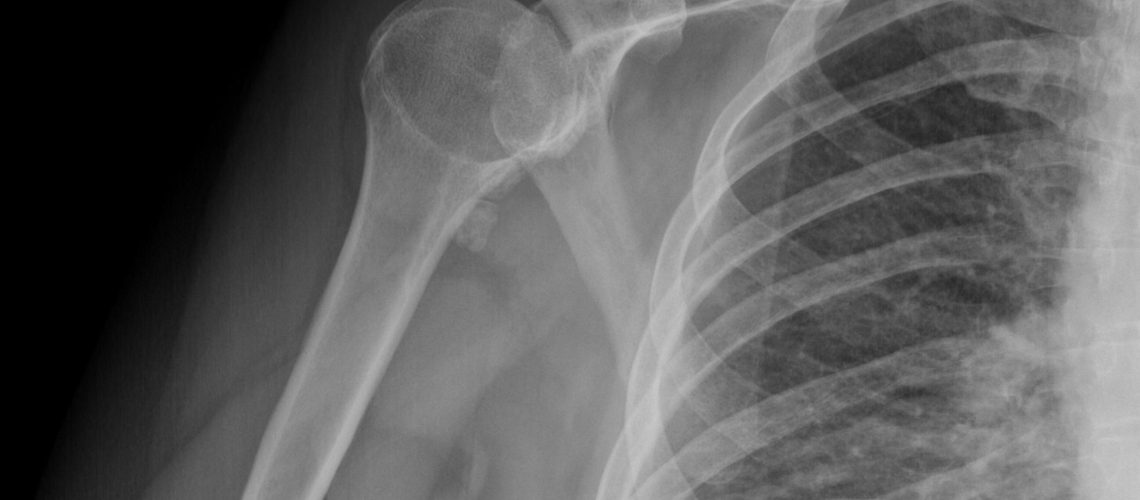 CALCIFIC TENDINITIS