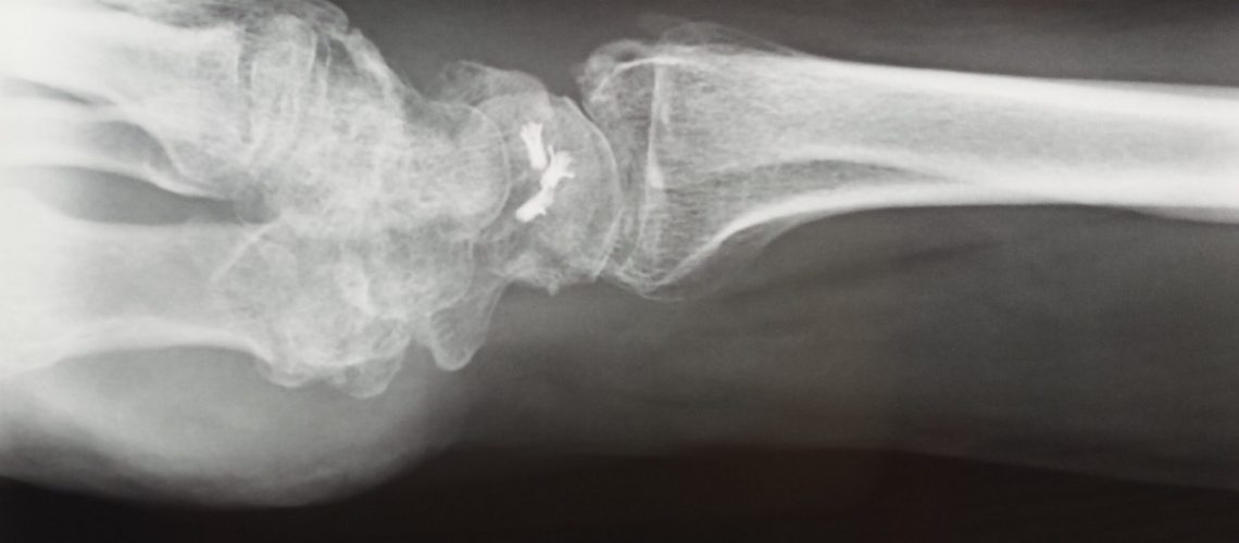 PERILUNATE FX DISLOCATION_POSTOP_XR