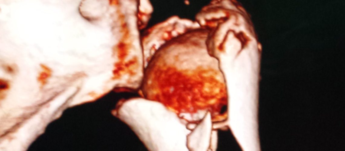 PHFx_4PART_PREOP