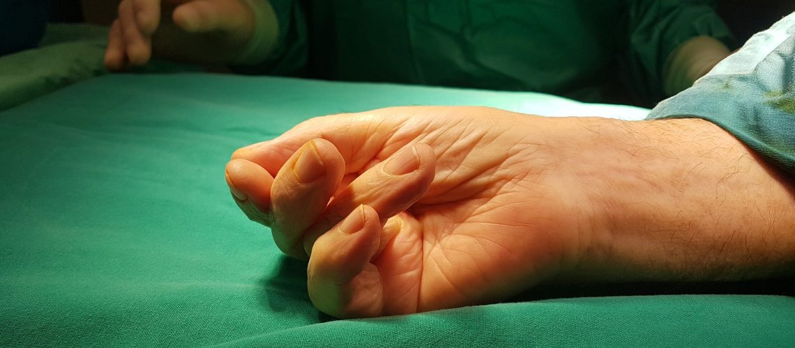 DUPUYTREN_PREOP