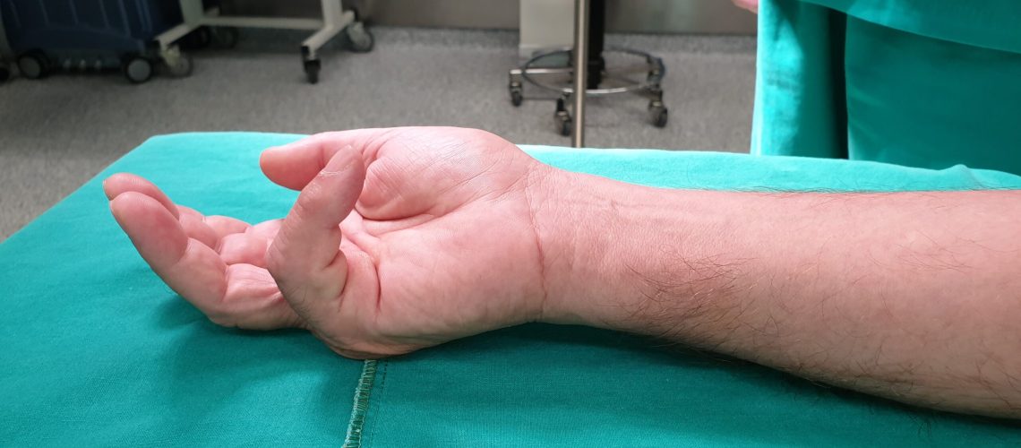DUPUYTREN_PREOP