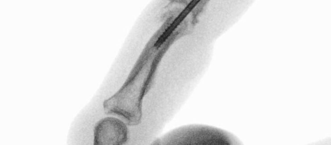PIP FUSION_INTRAOP