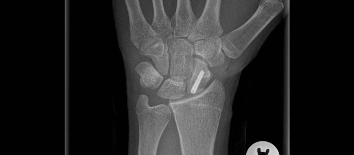 SCAPHOID FX_POSTOP XR_F
