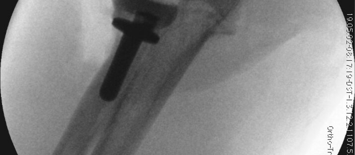 RADIAL HEAD_INTRAOP
