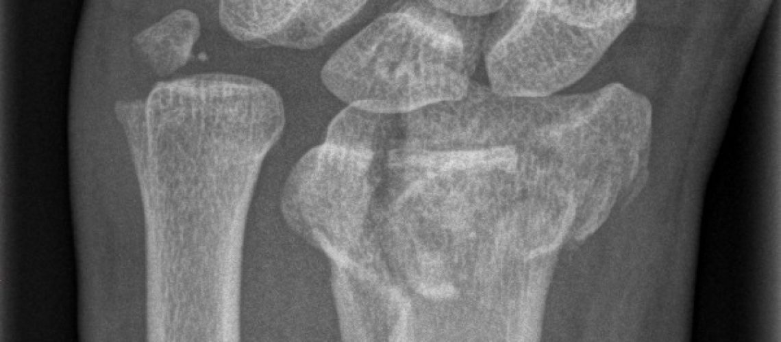 DRF_PREOP_F_ARTICULAR