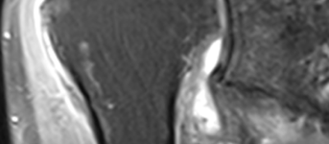 MASSIVE TAER_MRI