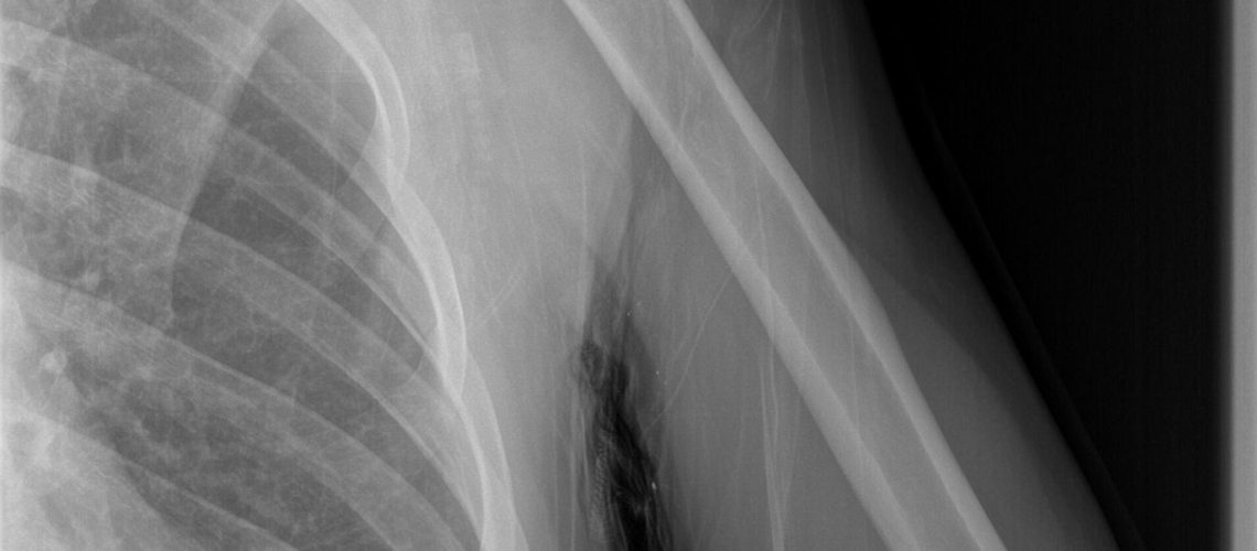 HUMERUS FX_PREOP