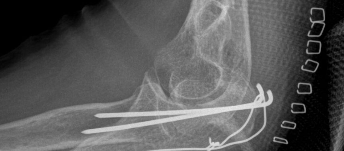 OLECRANON FX