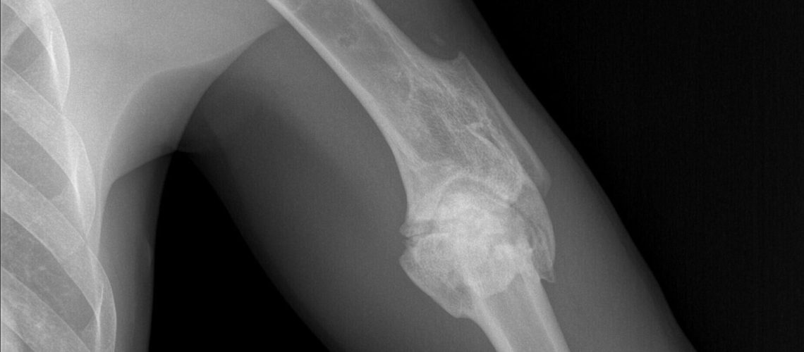 HUMERUS NONUNION F