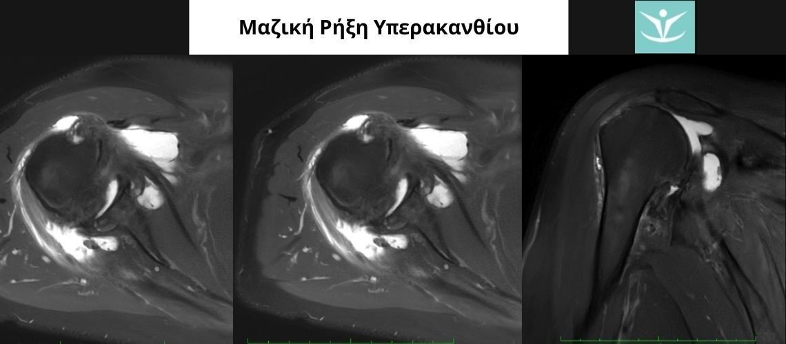 Μαζική Ρήξη Υπερακανθίου - 1