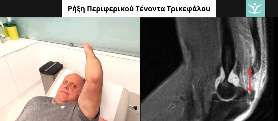 rixi-tenonta-trikefalou-article