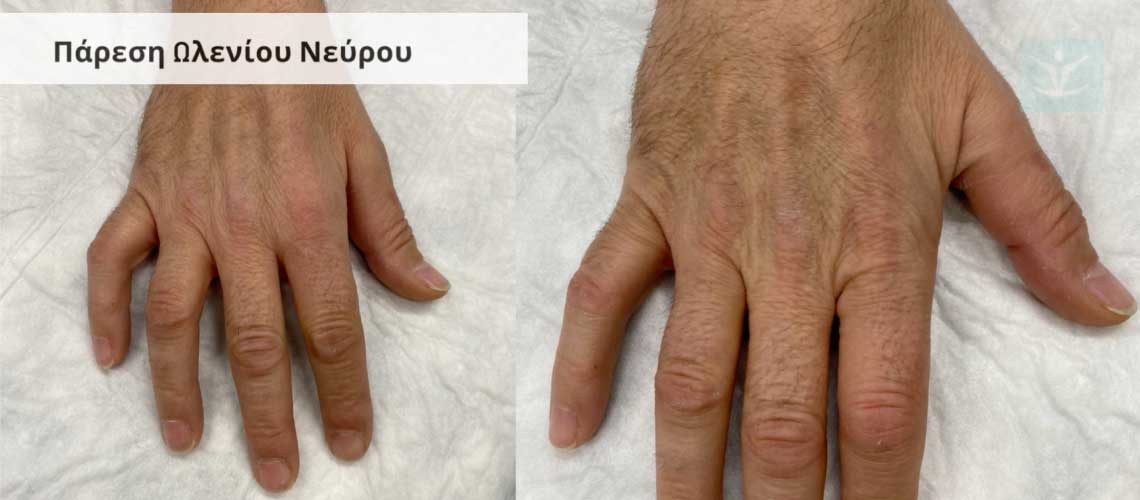 Πάρεση Ωλενίου Νεύρου Περιφερικού Τύπου - Διάνοιξη Καναλιού Guyon’s