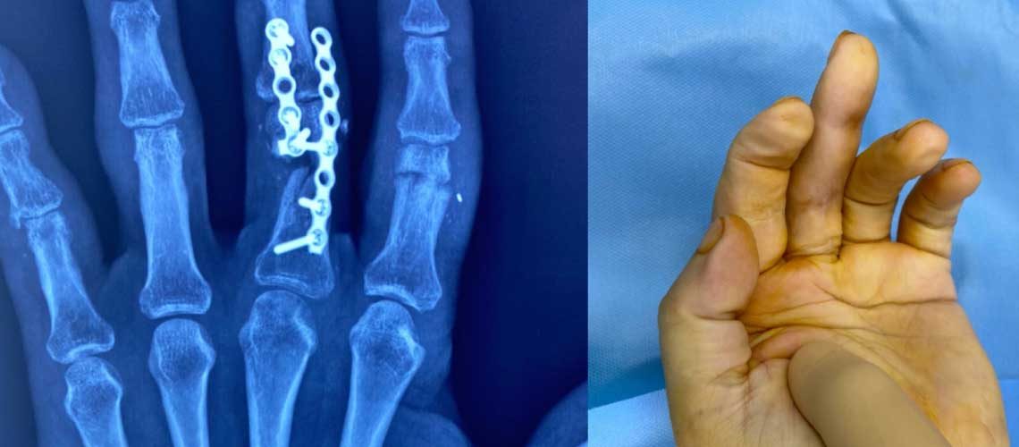 Ψευδάρθρωση Μέσης Φάλαγγας - Λύση Αρθρόδεσης Μέσου Δακτύλου